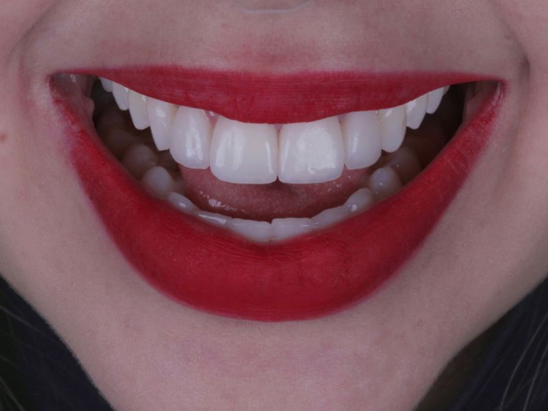 Clareamento dental realizado no Tatuapé com acompanhamento profissional