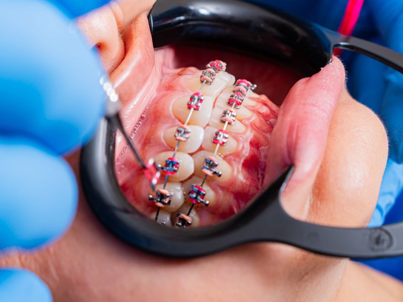 Tratamento ortodôntico realizado no Tatuapé