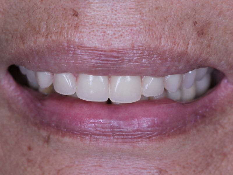 Tratamento de reabilitação oral realizado no Tatuapé