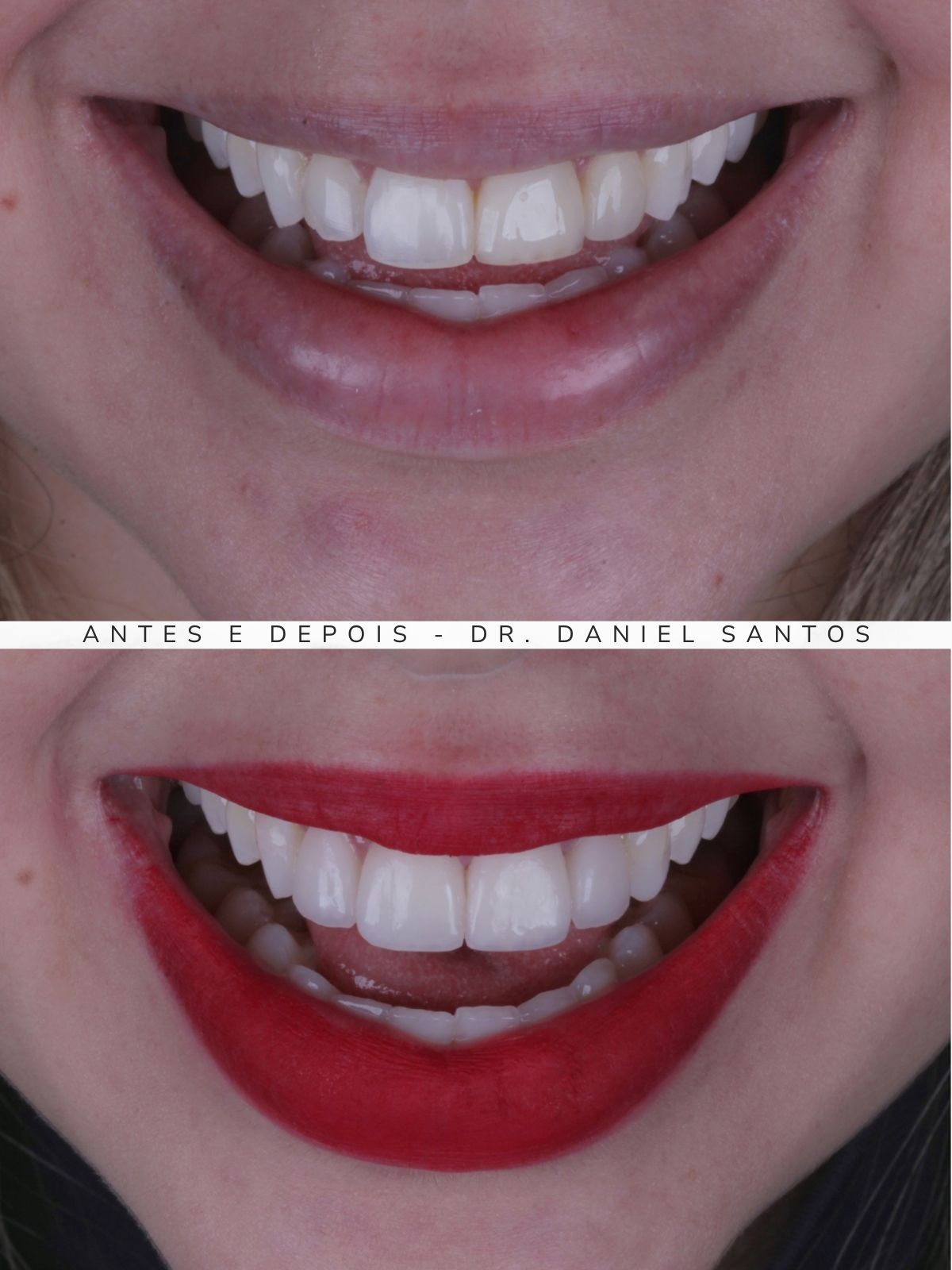 Resultado de clareamento dental realizado na Premiere Odontologia Personalizada.