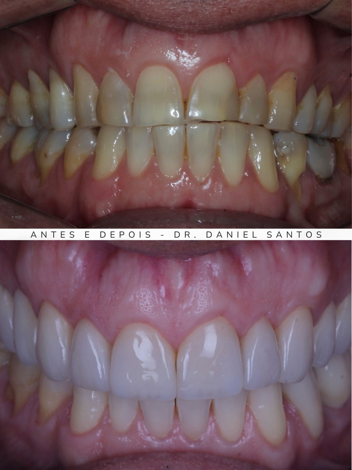 Resultado de clareamento dental realizado na Premiere Odontologia Personalizada.