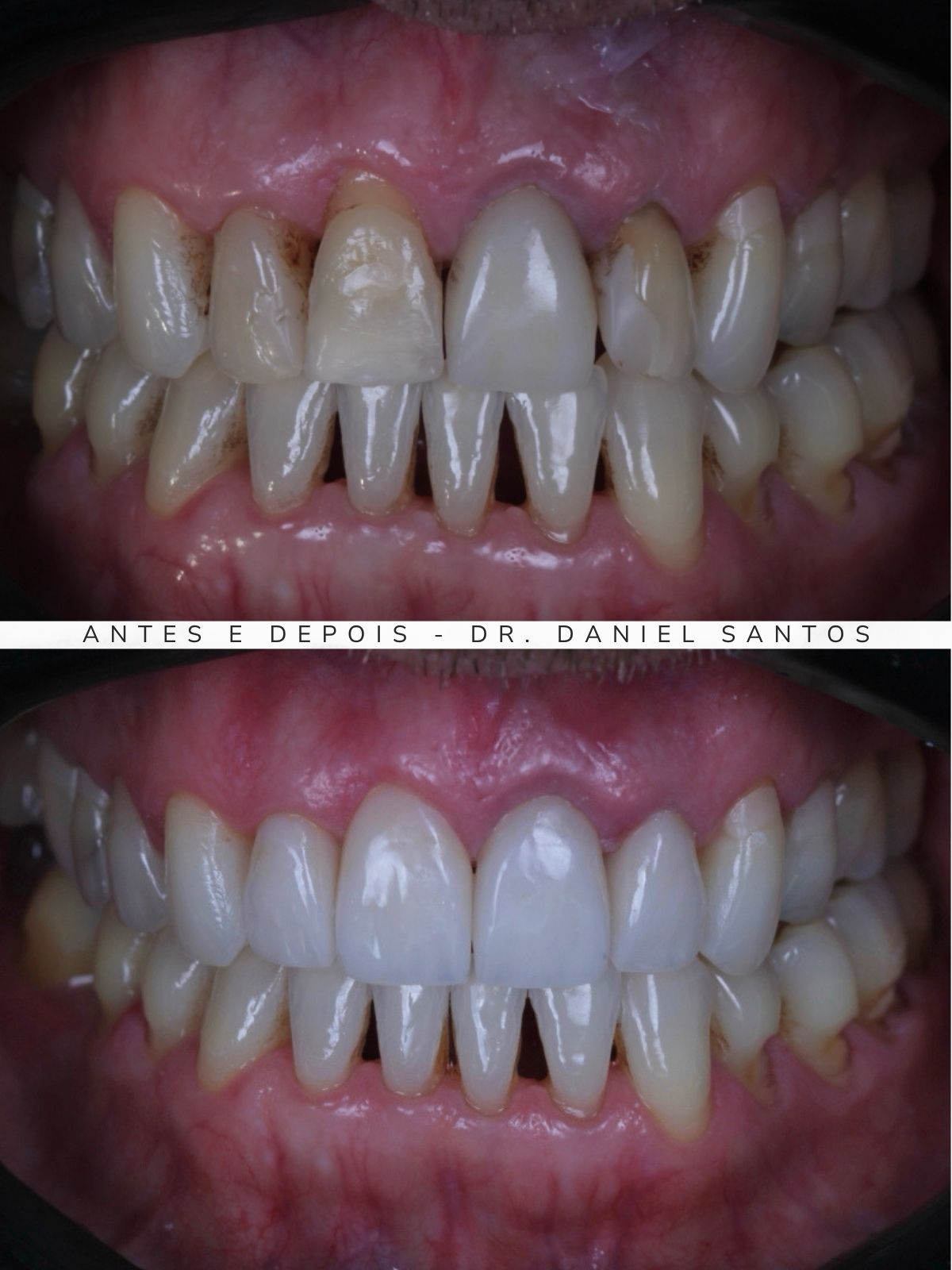 Resultado de clareamento dental realizado na Premiere Odontologia Personalizada.