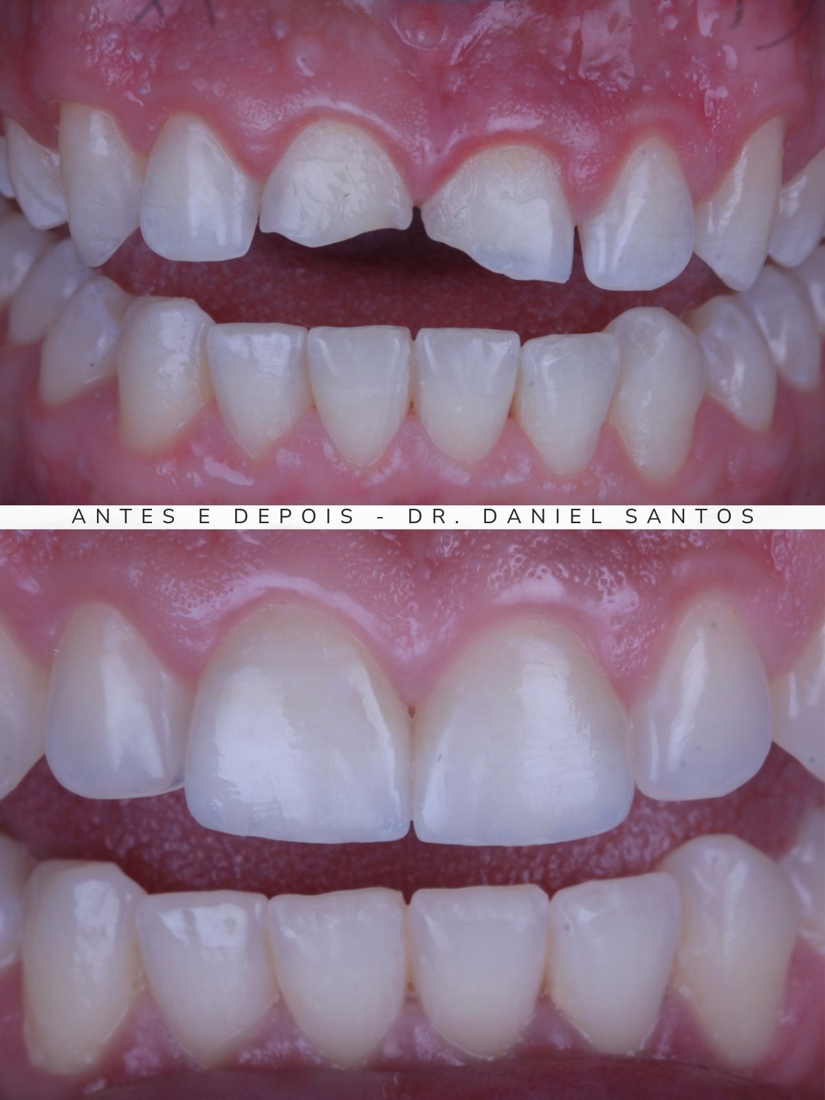 Resultado de tratamento com faceta de porcelana realizado na Premiere Odontologia Personalizada.