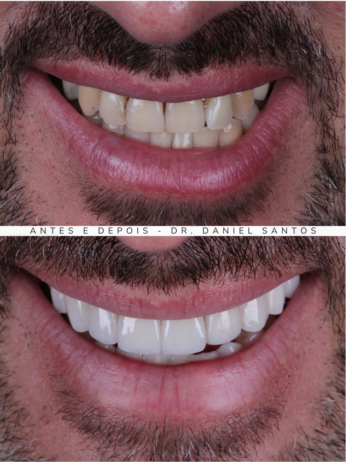Resultado de tratamento com faceta de porcelana realizado na Premiere Odontologia Personalizada.