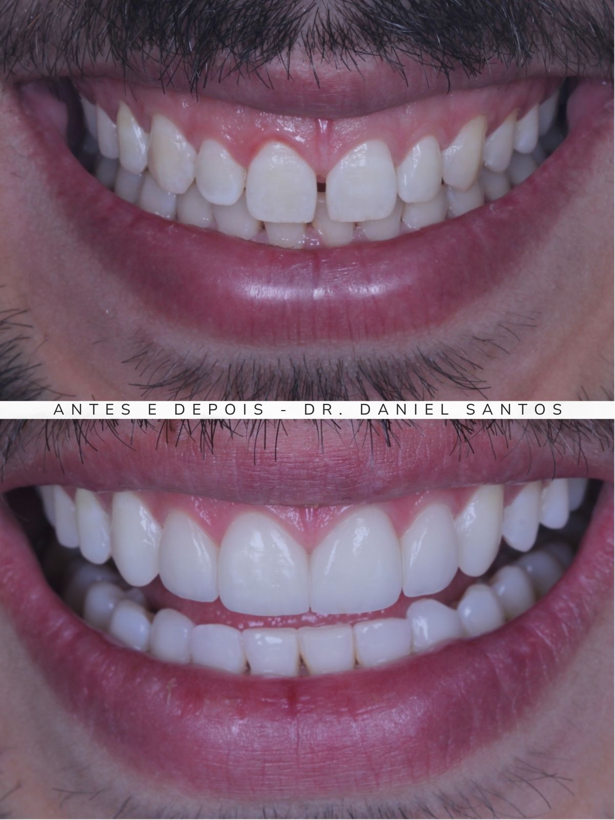 Resultado de tratamento com faceta de porcelana realizado na Premiere Odontologia Personalizada.