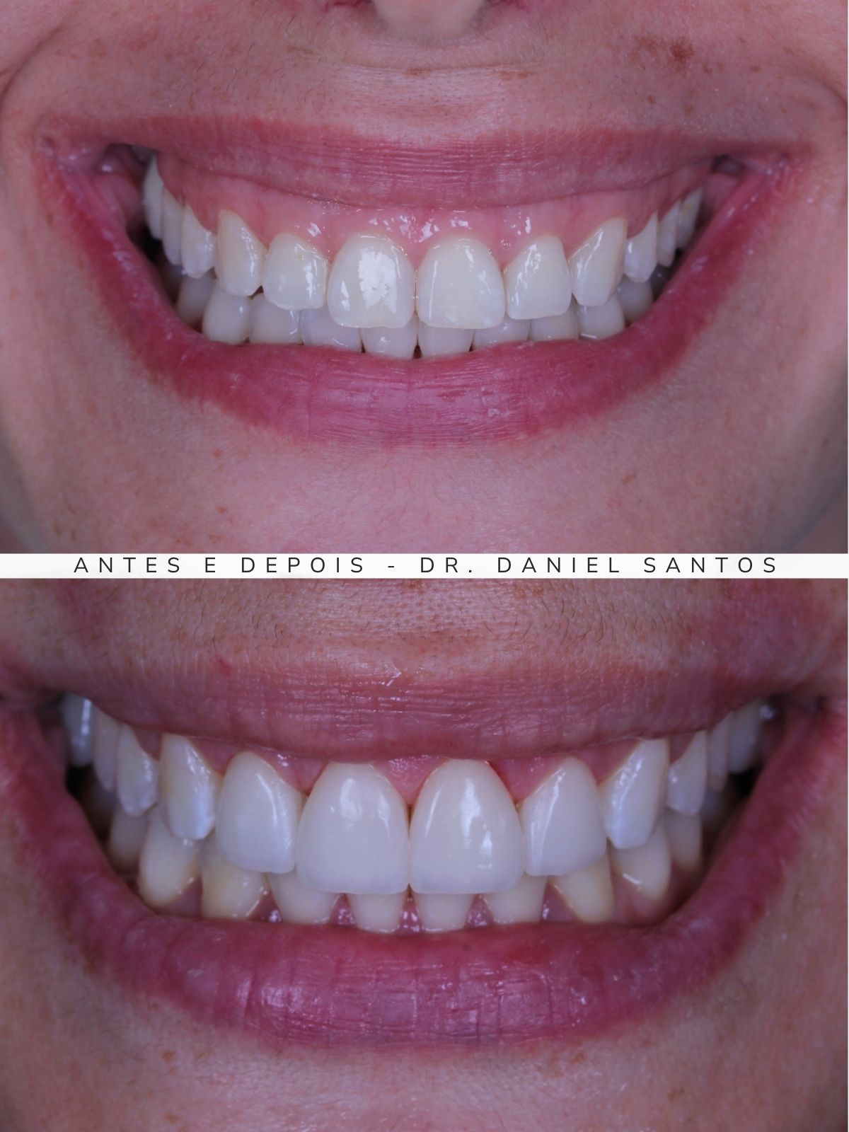 gengivoplastia-no-tatuape-antes-e-depois