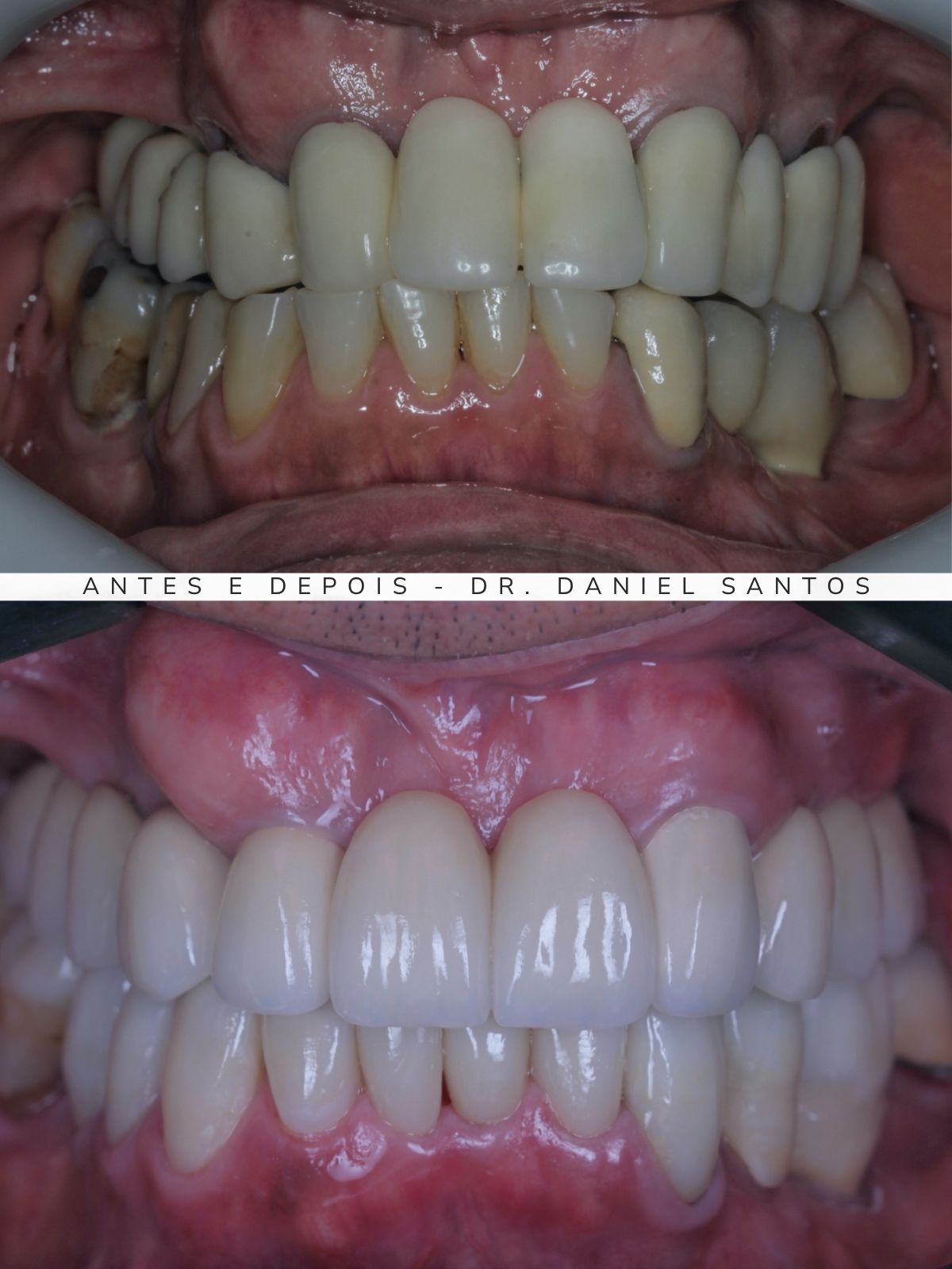 Resultado de reabilitação estética realizada na Premiere Odontologia Personalizada.