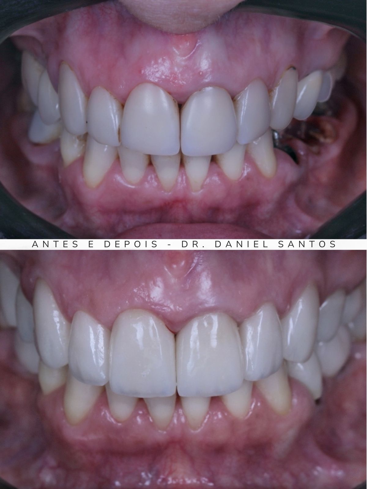 Resultado de reabilitação estética realizada na Premiere Odontologia Personalizada.