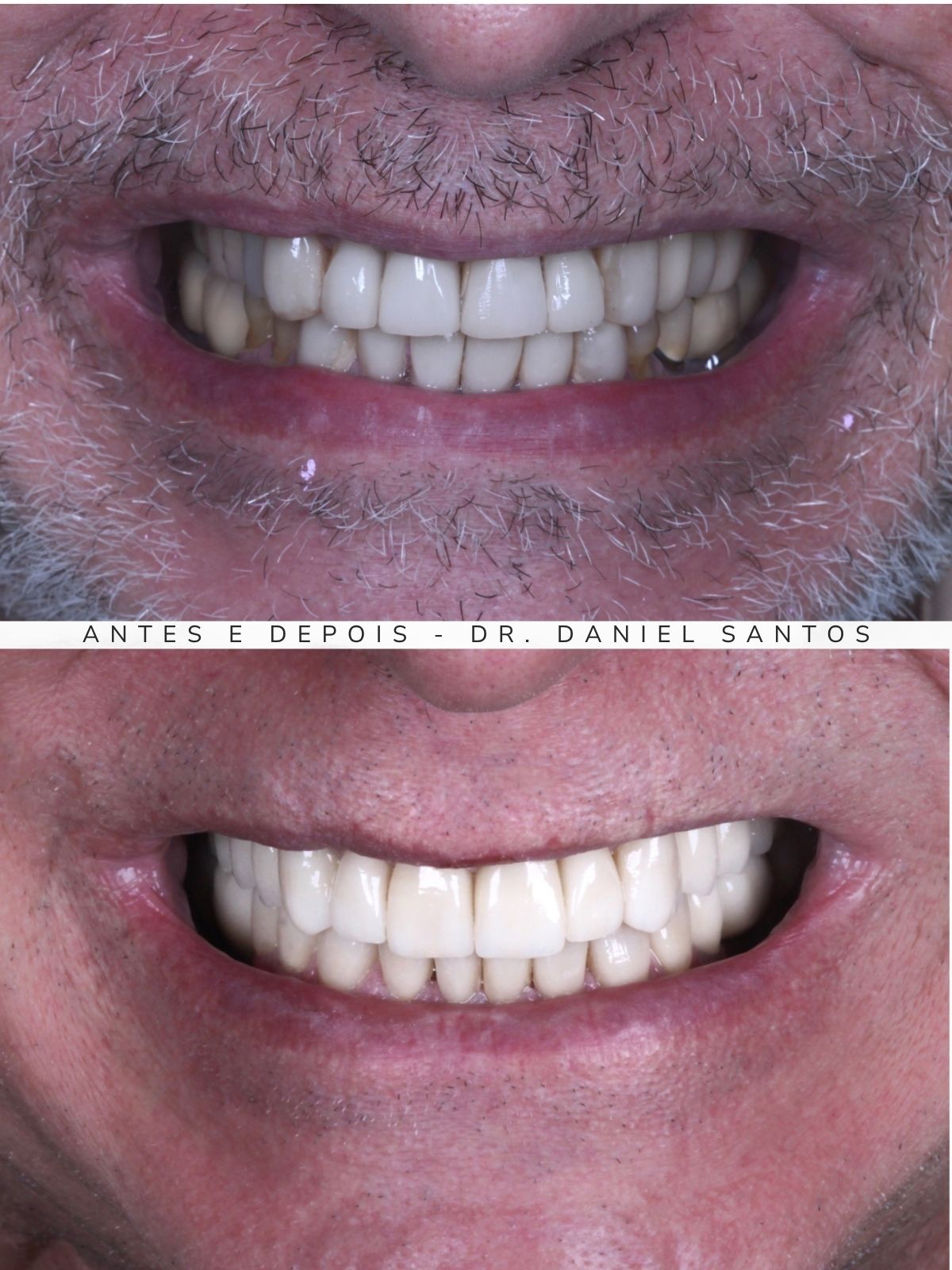 Resultado de reabilitação estética realizada na Premiere Odontologia Personalizada.