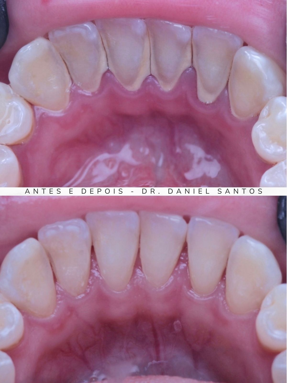 Resultado de reabilitação estética realizada na Premiere Odontologia Personalizada.