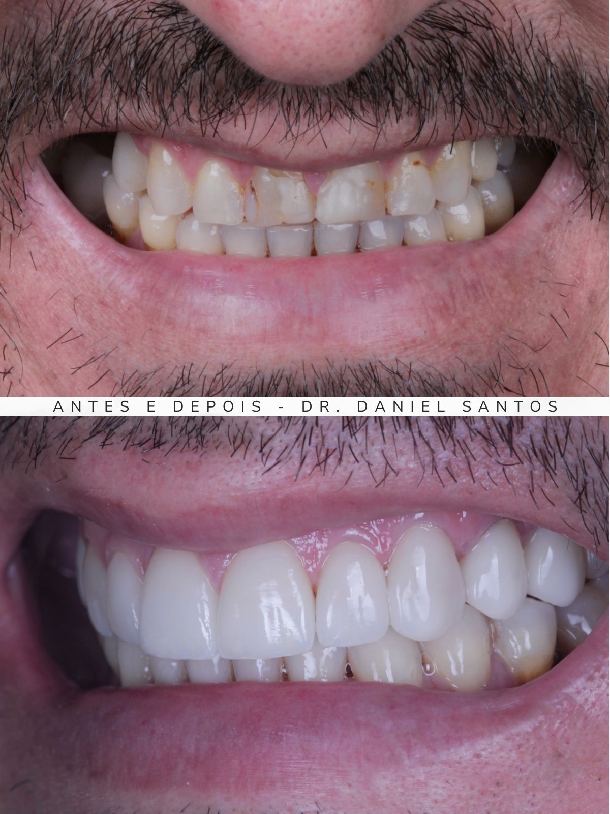 Resultado de reabilitação estética realizada na Premiere Odontologia Personalizada.